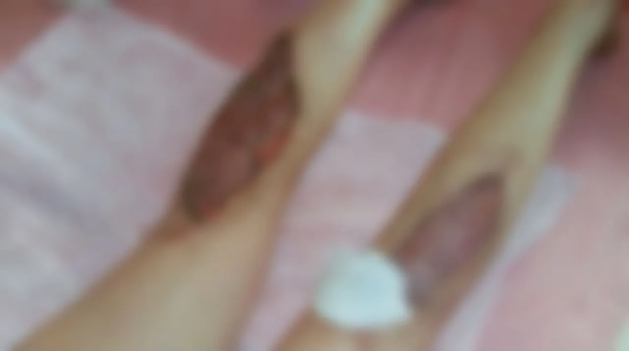 Varicose vein risk illustration