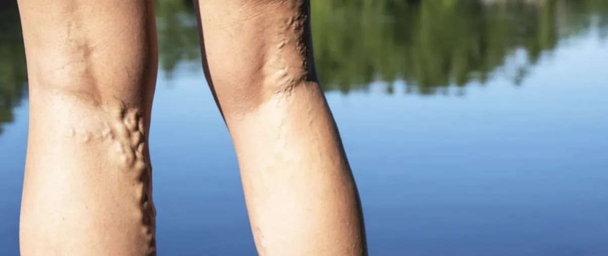 Hidden dangers of varicose veins